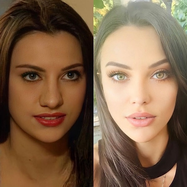 Tuvana Türkay estetik operasyonlarına bir yenisini daha ekledi - Resim : 2