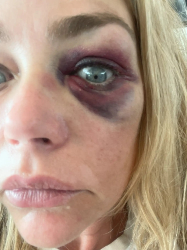 Kocası tarafından darp edilen güzel oyuncu uzaklaştırma kararı aldırdı