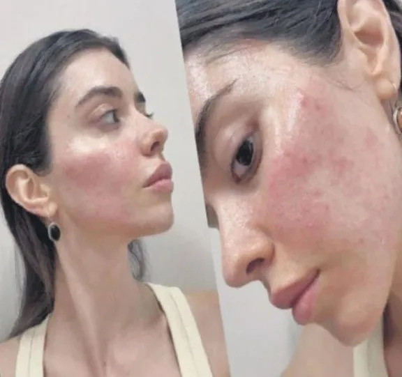 Eski Türkiye Güzeli sosyal medya ürünleri yüzünden cilt sorunları yaşadı